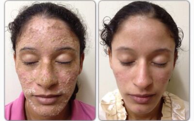 dermatitis seborreica