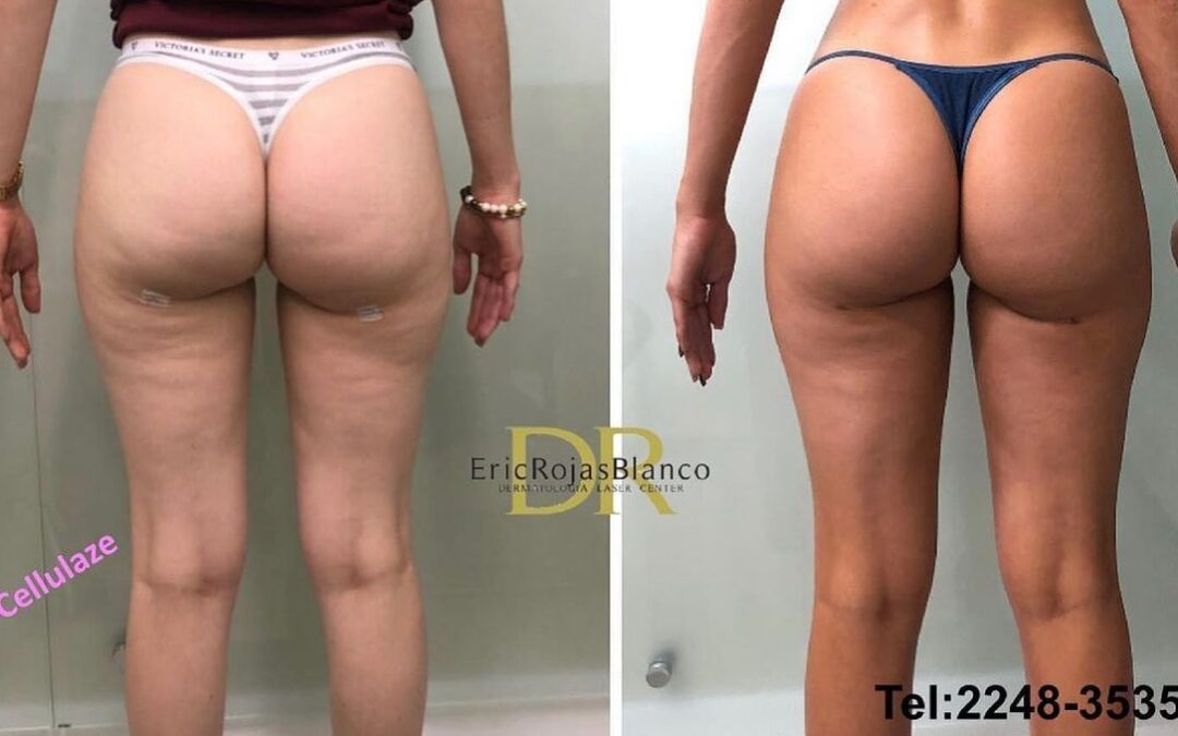 Tratamiento para las celulitis