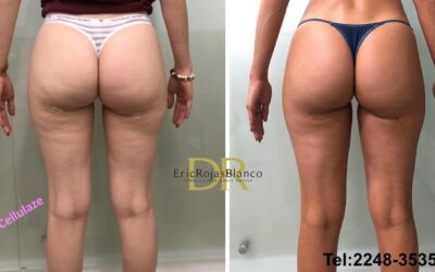 Tratamiento para las celulitis