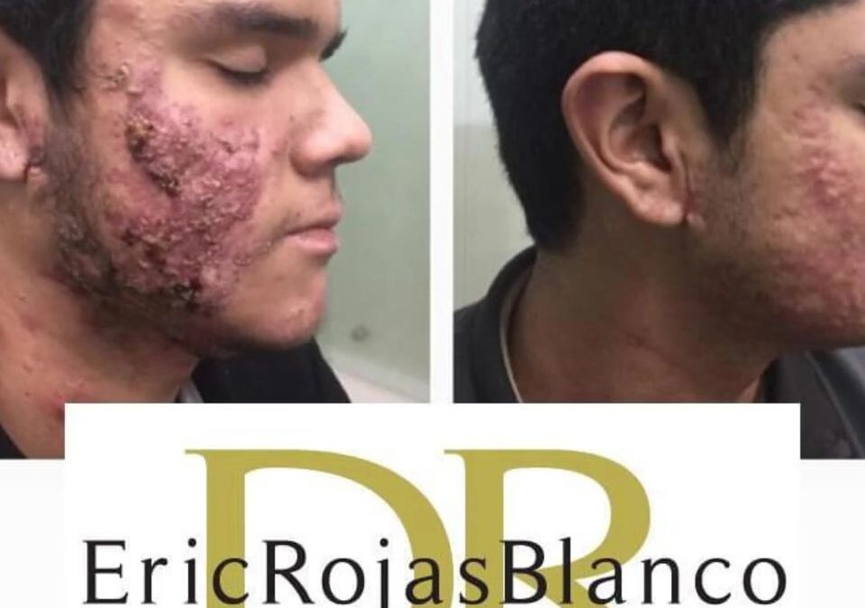 El acné sí se puede tratar y se puede curar.