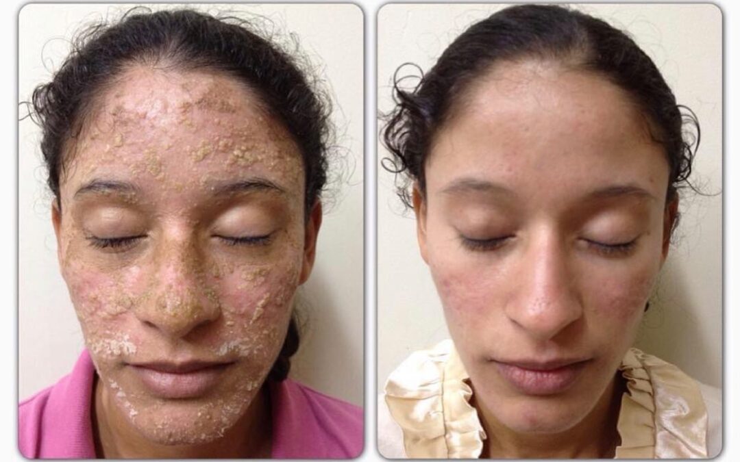 Dermatitis seborreica Severa