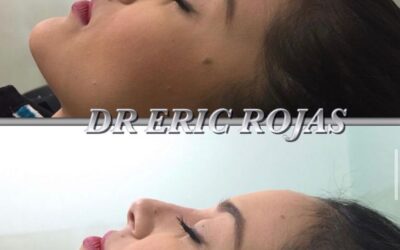 Nariz sin cirugía Doctor Eric Rojas