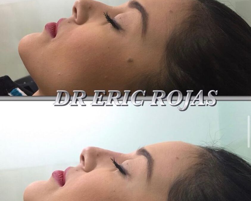 Nariz sin cirugía Doctor Eric Rojas