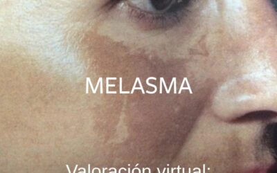 Melasma