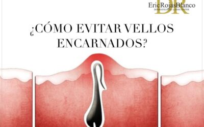 Los vellos encarnados