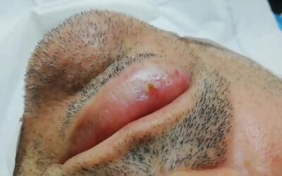 Carcinoma Epidermoide de Labio