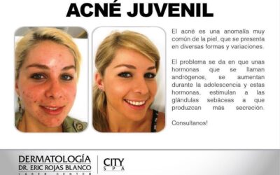 Afecta a la mayoría; bien tratado se puede eliminar.