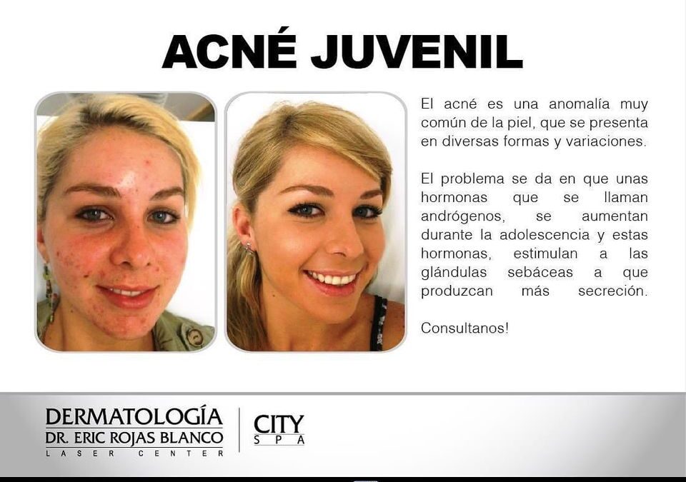 Afecta a la mayoría; bien tratado se puede eliminar.