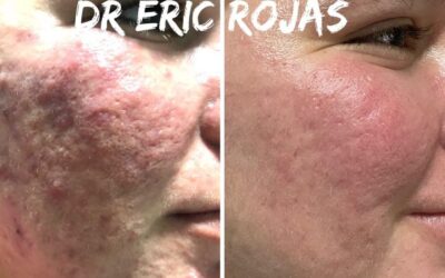 Rosácea ya no más DR ÉRIC ROJAS 22483535