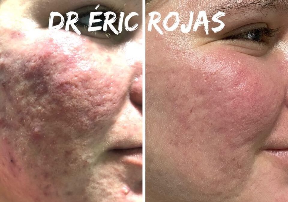 Rosácea ya no más DR ÉRIC ROJAS 22483535