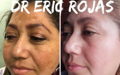 Eliminación de manchas en el rostro .