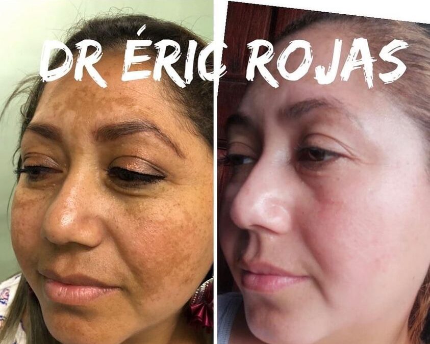 Eliminación de manchas en el rostro .