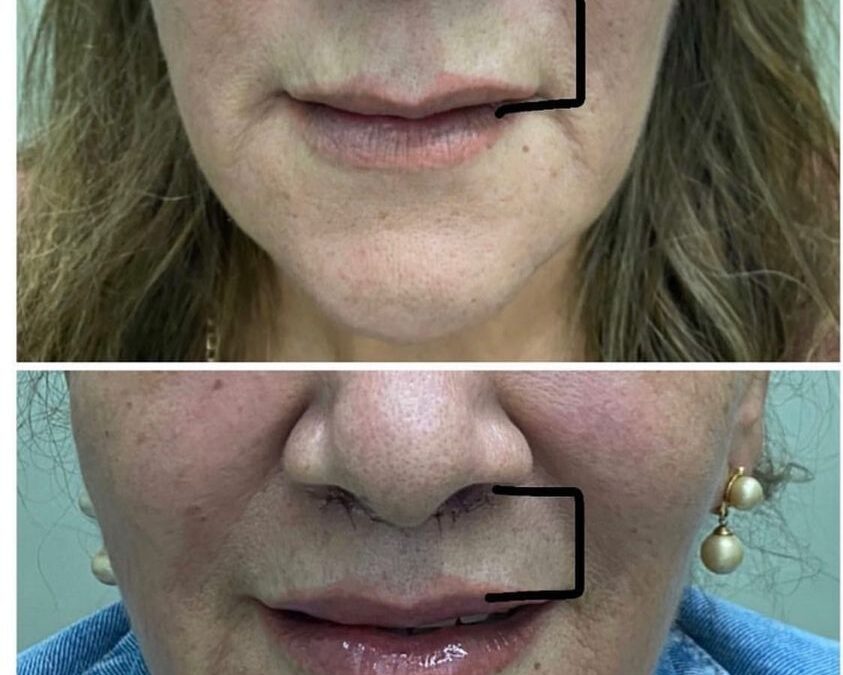 Acotamiento de labio superior!