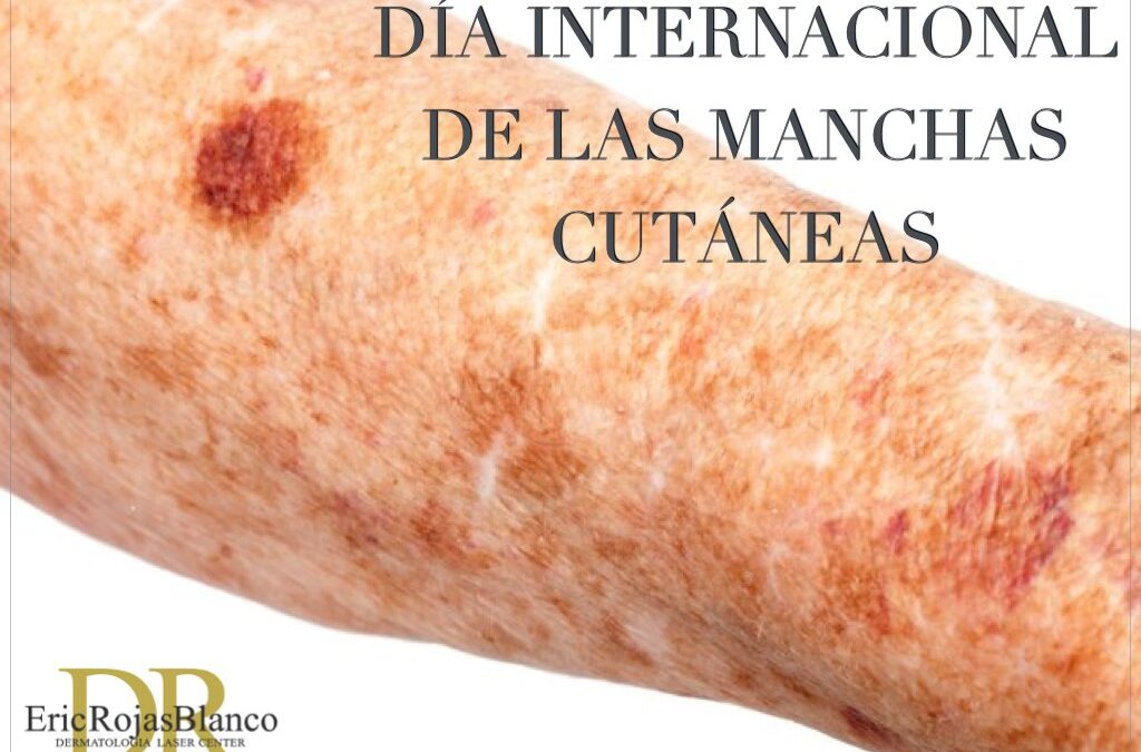Día Internacional de las Manchas Cutáneas