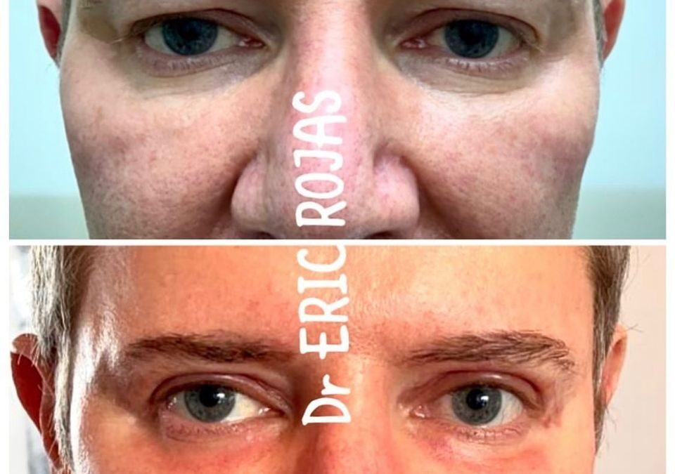 Dermablefaroplastia láser!