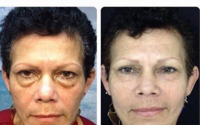 Rejuvenecimiento Facial