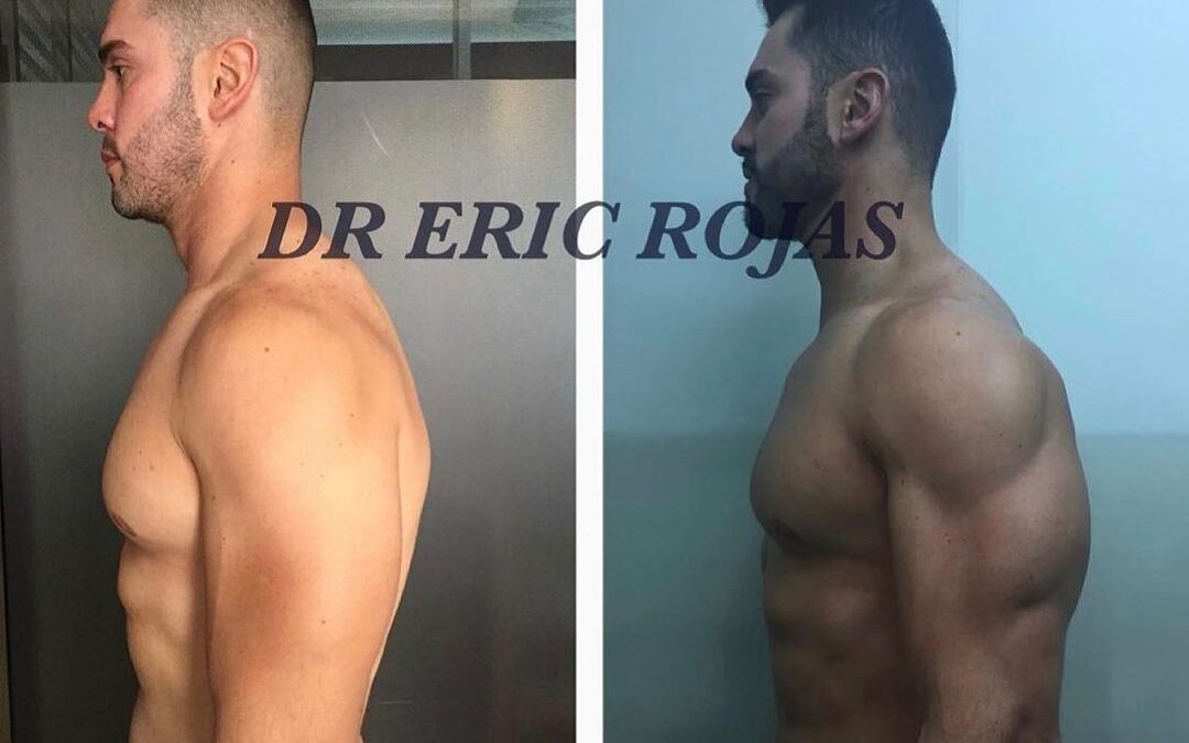 Slim laser en brazos