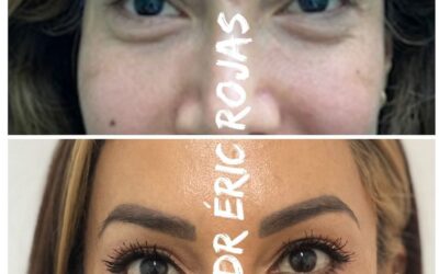 DERMO BLEFAROPLASTIA DR ÉRIC ROJAS 22483535