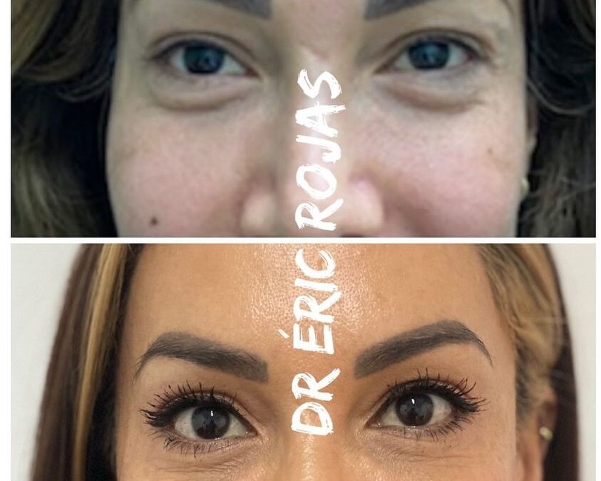DERMO BLEFAROPLASTIA DR ÉRIC ROJAS 22483535