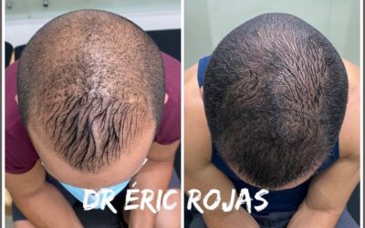 PERDIDA DE CABELLO YA NO MAS