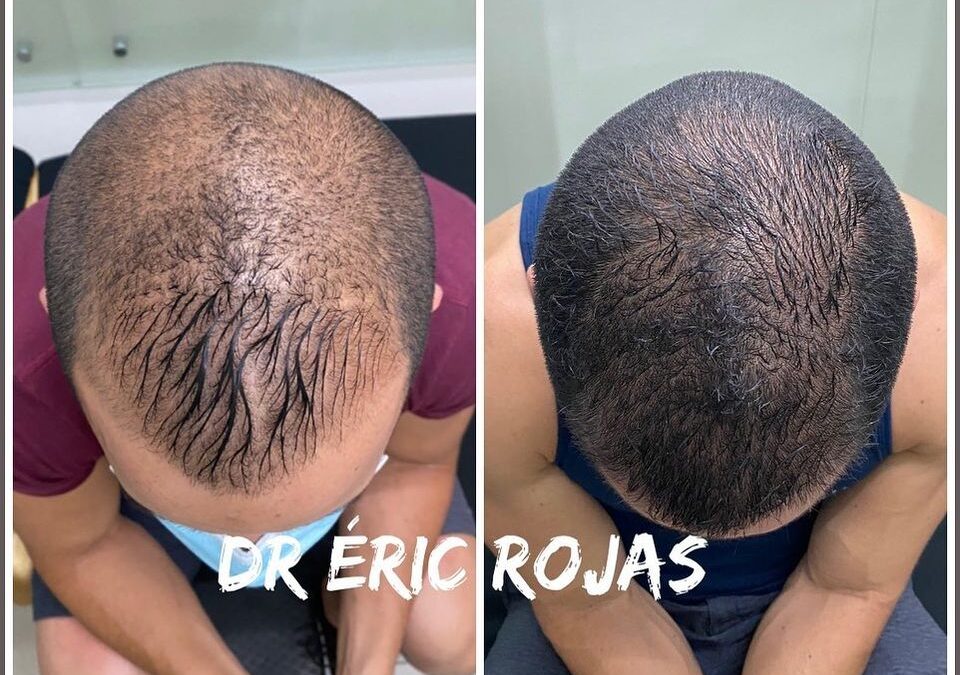 PERDIDA DE CABELLO YA NO MAS