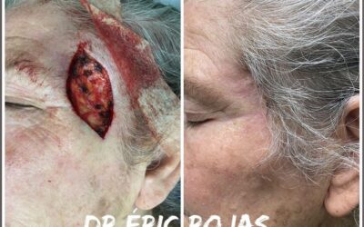 Cancer de PIEL DR ÉRIC ROJAS