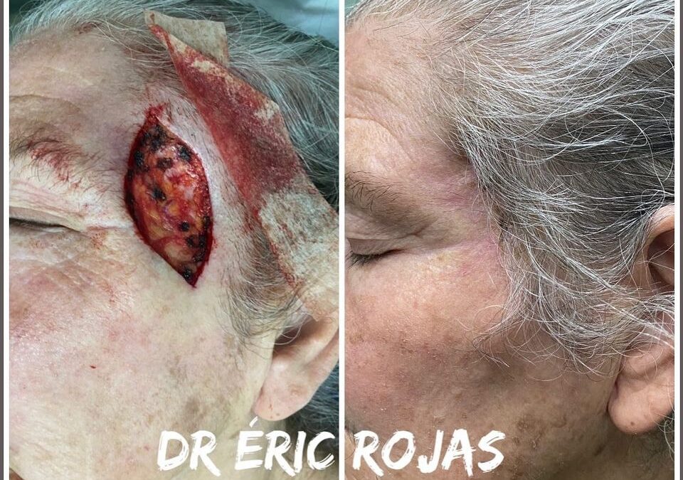 Cancer de PIEL DR ÉRIC ROJAS