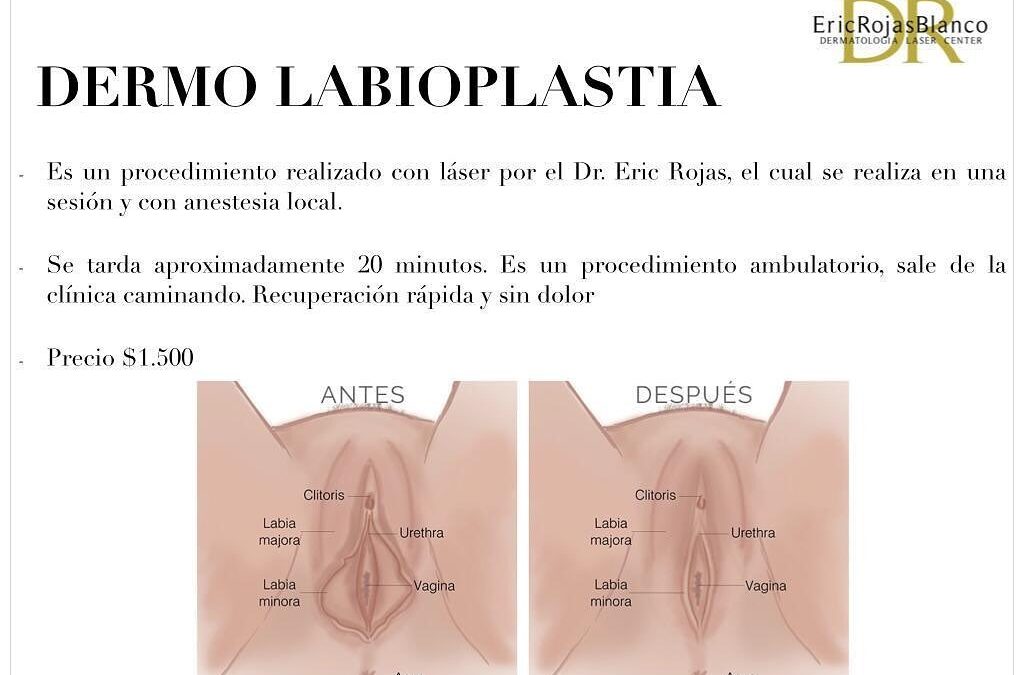 Dermo labioplastia