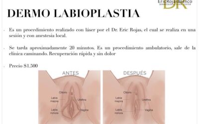 Dermo labioplastia