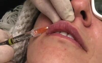 Relleno de labios