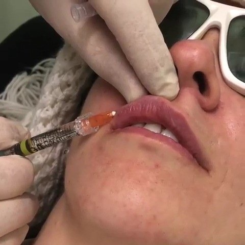 Relleno de labios