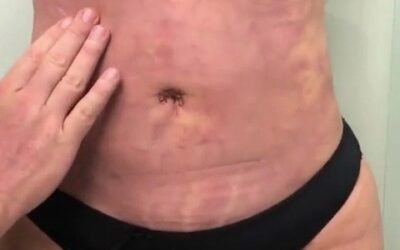 SLIM LASER – EXCLUSIVO DR. ERIC ROJAS