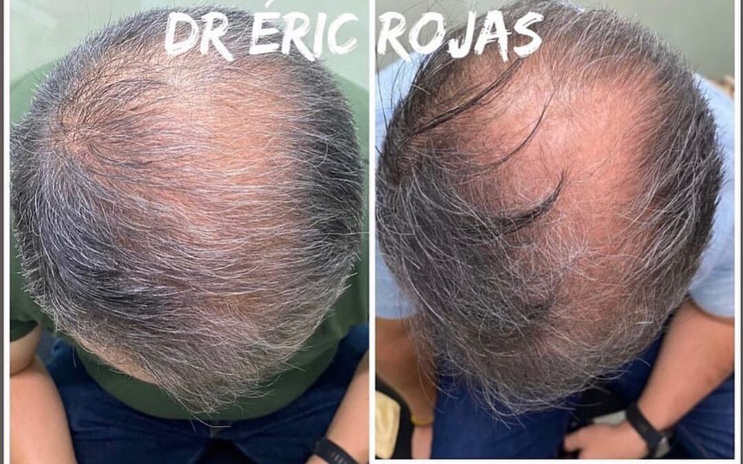 Tienes pérdida de cabello?