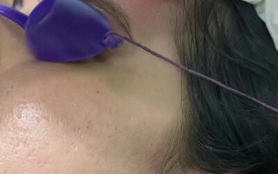 Tratamiento para disminuir las cicatrices del acné.