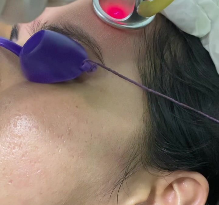 Tratamiento para disminuir las cicatrices del acné.