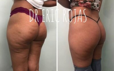 Celulitis ya no más