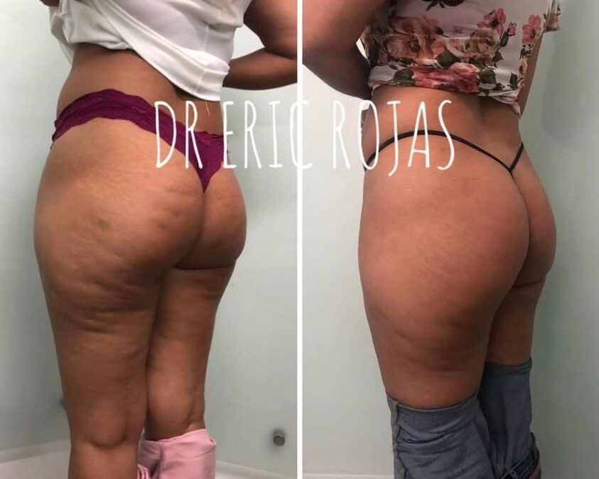 Celulitis ya no más