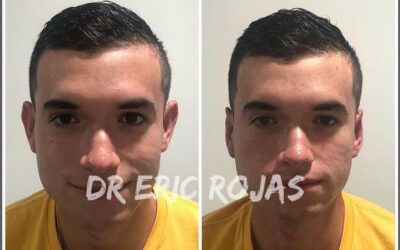 Corrección de orejas