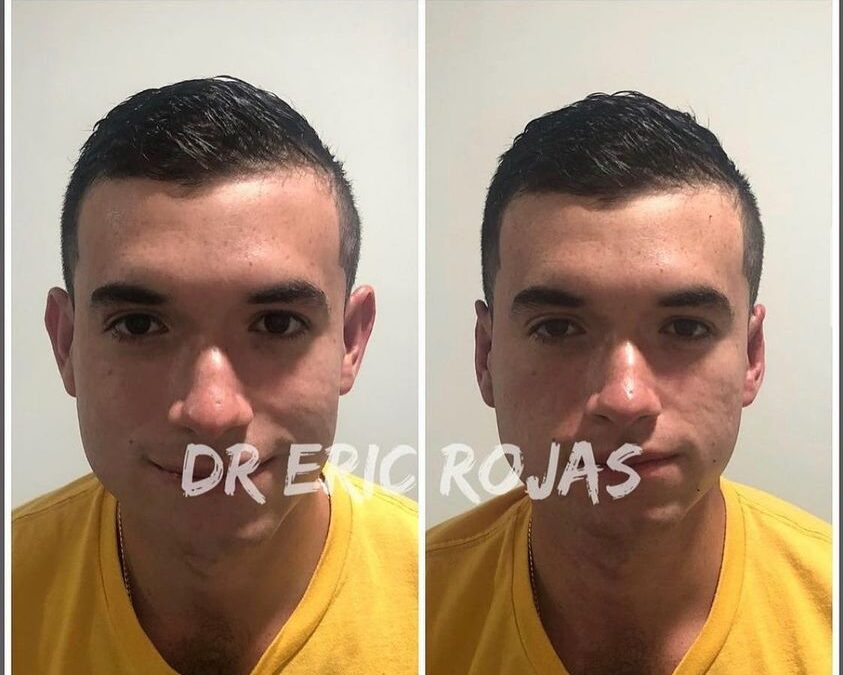 Corrección de orejas