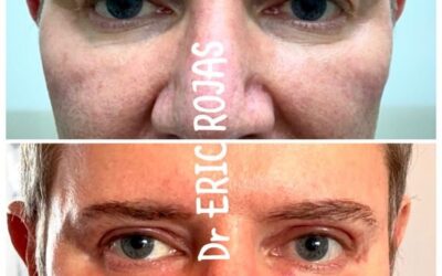 Dermablefaroplastia láser!