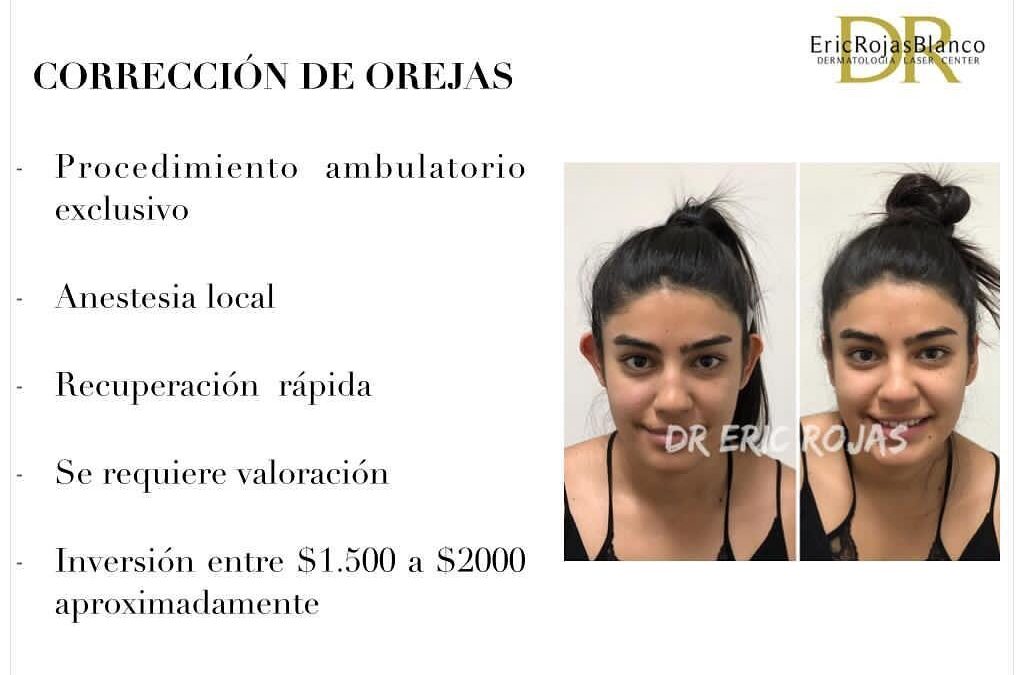Corrección de orejas