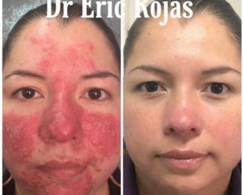 Tratamos la rosacea
