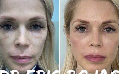 Rejuvenecimiento facial