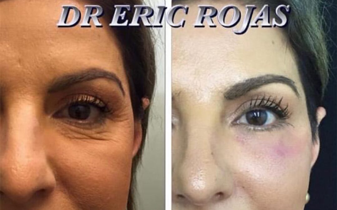 Tenemos el mejor tratamiento de rejuvenecimiento facial.