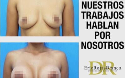 Aumento de mamas