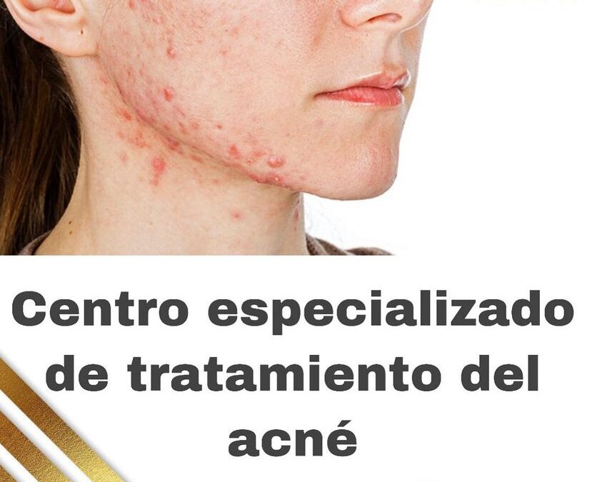 Si tienes problemas de acné estamos para ayudarte