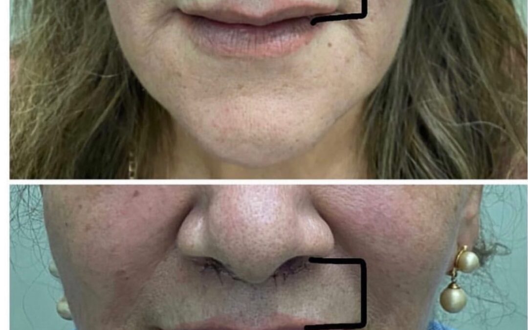Acotamiento de labio superior