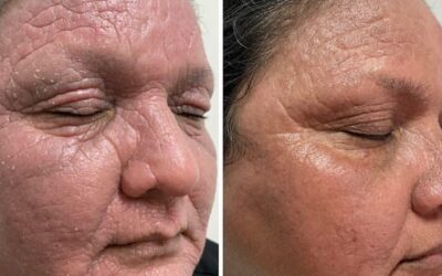 Dermatitis severa 2 años de no mejorar y con nosotros en 15 días.