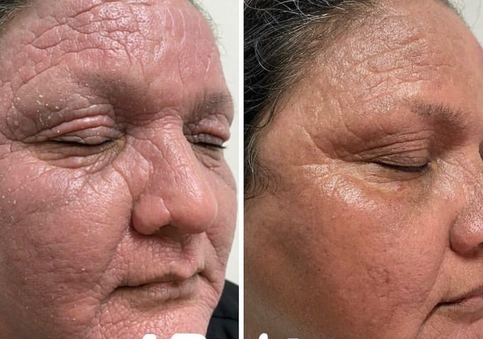 Dermatitis severa 2 años de no mejorar y con nosotros en 15 días.