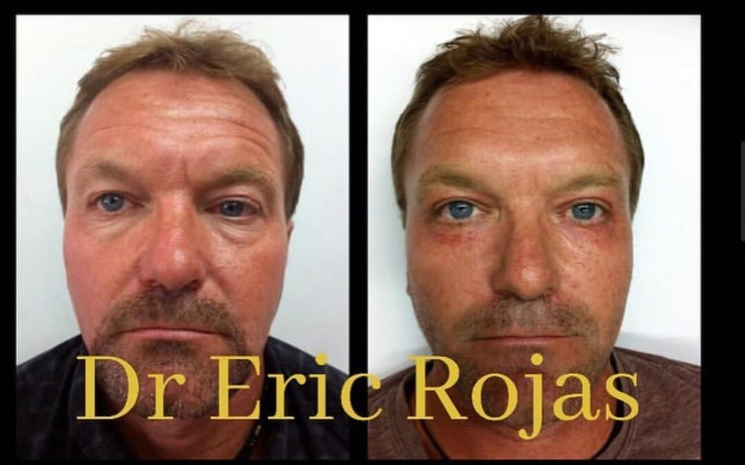 Rejuvenecimiento Facial